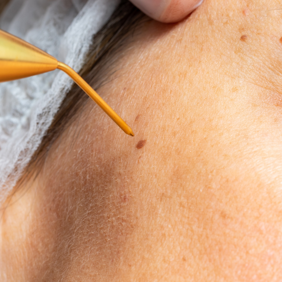 Snow Fibroblast Plasma Pen for skin tags, skin tightening, age spots, dark spots, and more - Snow Skin Co