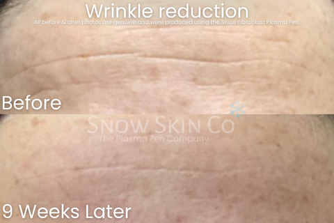 Snow Fibroblast Plasma Pen