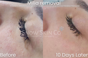 Snow Skin Co,
Plasma Pen Before & After,
Milia removal,
Milia removal with plasma pen,
Plasma pen milia removal